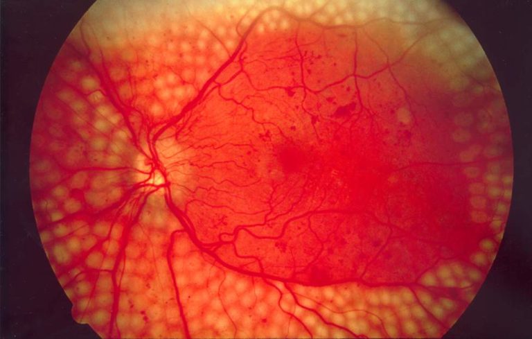 diabetic retinopathy