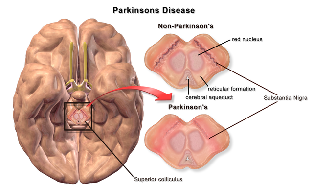 Parkinsons Disease