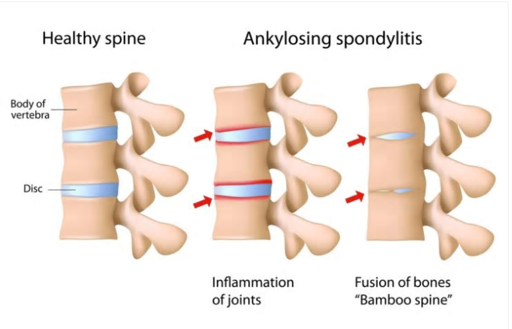 Ankylosing Spondylitis