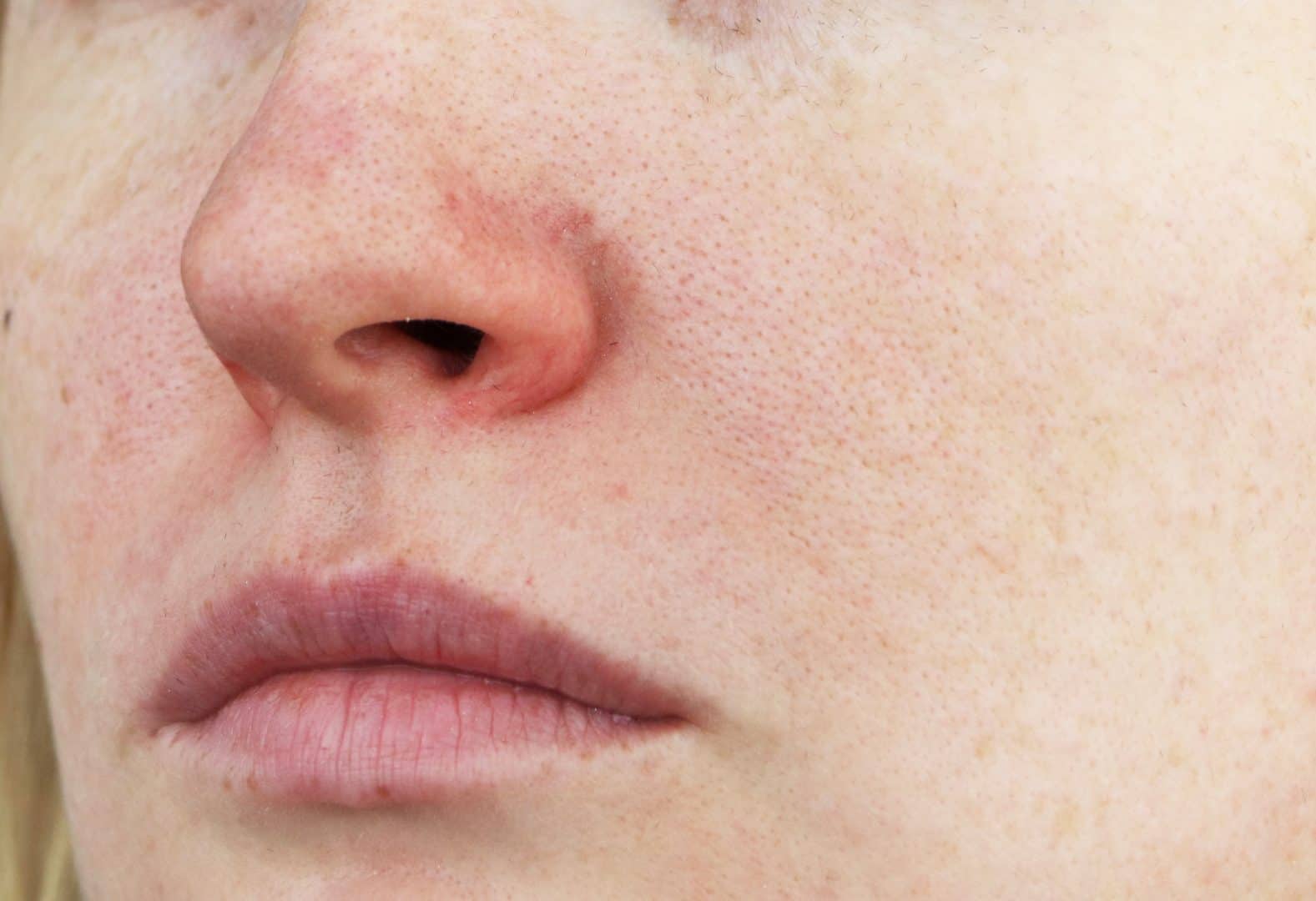 Rosacea