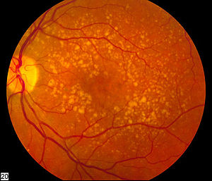 age related macular degeneration