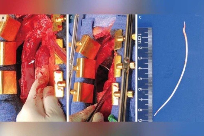 Man had a 4 inch piece of cement in his heart